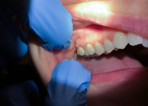 Best Emergency Root Canal Treatment in Baltimore Highlands, MD